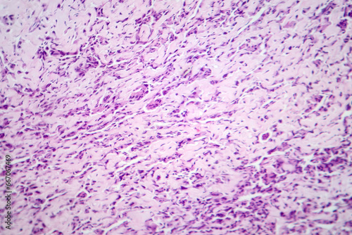 Osteosarcoma, a malignant bone tumor, light micrograph under the microscope