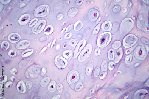 Photomicrograph of chondrosarcoma, showcasing the cellular details of this malignant cartilage tumor under the microscope photo
