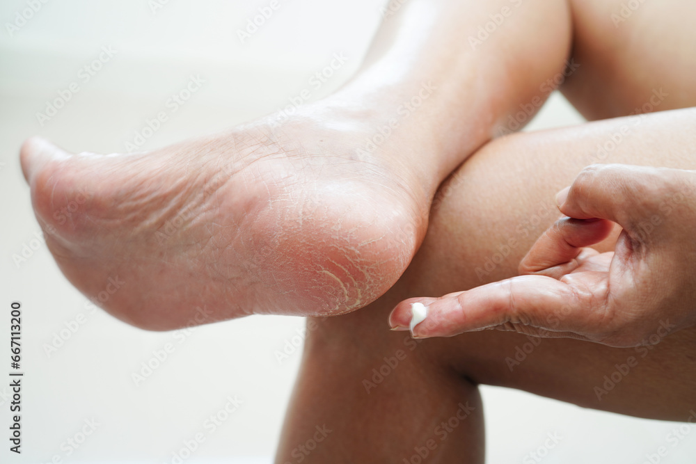 Asian woman applying moisturizing cream skincare treatment to solve and repair feet with crack and dry heel skin. - obrazy, fototapety, plakaty 