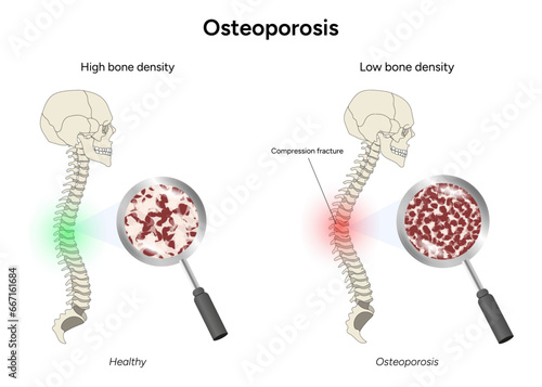 Osteoporosis and healthy spine medical illustration in vector