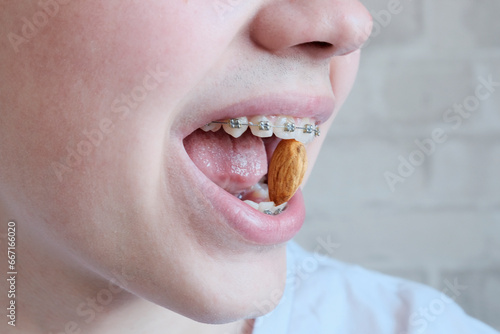 Teenager young man, European, close-up of braces on his teeth. Biting almond nuts. Concept of dental hygiene, prosthetics, permitted products for braces.