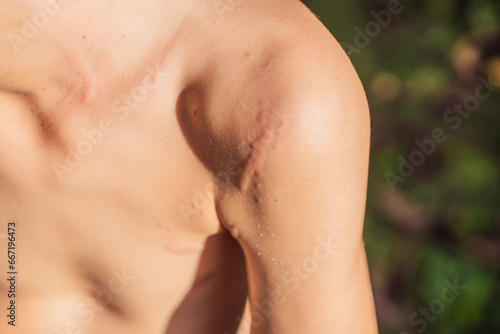 Картината върху платно Instant pain: a boy's shoulder stung by a jellyfish