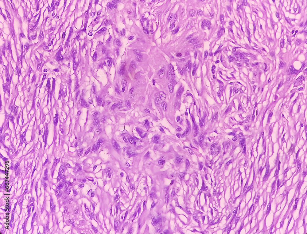 Olfactory groove tumor (biopsy): Brain cancer, Meningioma, show fibroblastic meningioma. Malignant tumor.