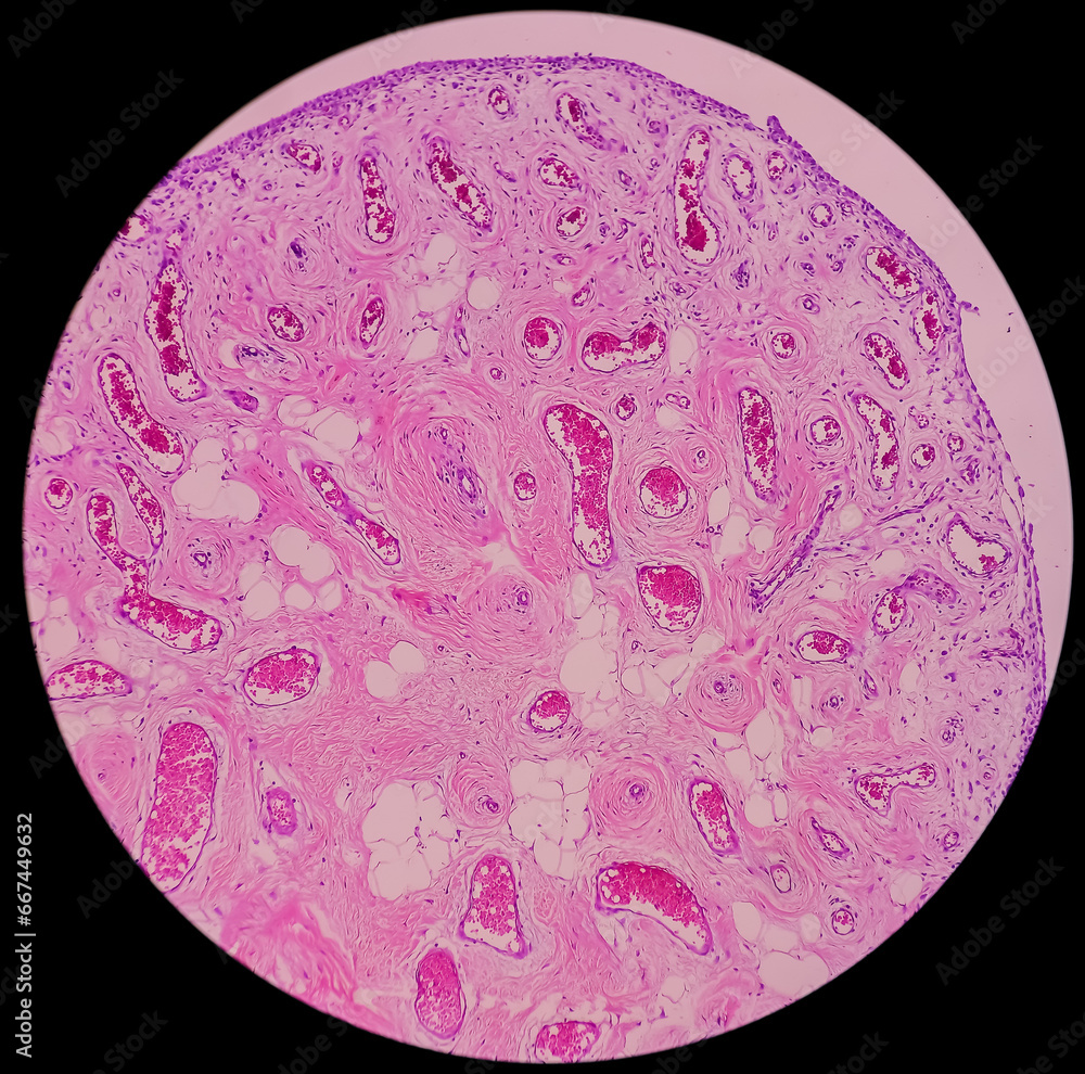Microscopic image of Synovial tissue of knee joint. Baker's cyst. Ganglion cells, show microscopic view cyst wall composed of hyalinized fibrocollagenous tissue lined by synovium. Microscopic image of Synovial tissue of knee joint. Baker's cyst. Ganglion cells, show microscopic view cyst wall composed of hyalinized fibrocollagenous tissue lined by synovium.