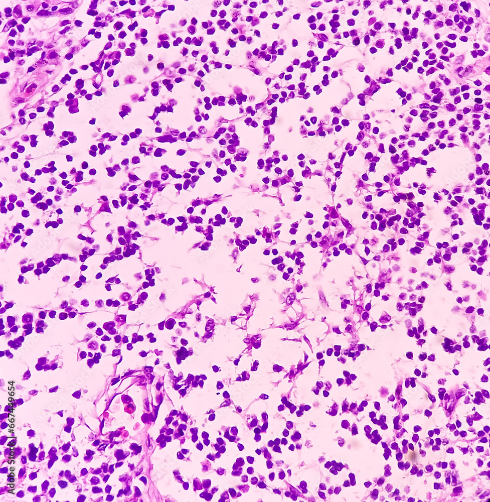 Microscopic image of Synovial tissue of knee joint. Baker's cyst