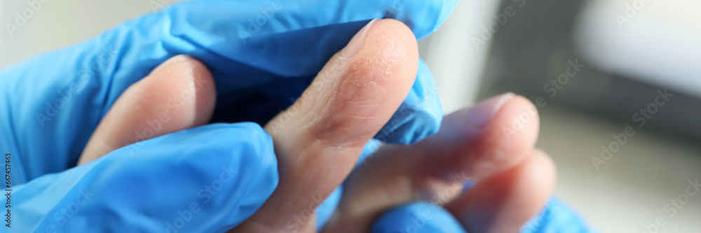 Doctor in rubber gloves examines patient fingers with eczema