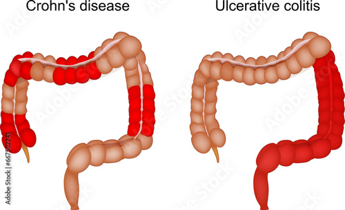 Inflammatory bowel disease. large intestine. Crohn disease and Ulcerative colitis.