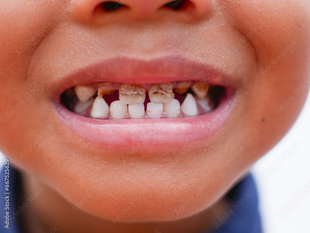 Obraz premium close up of black boy showing caries on teeth. health and dental care
