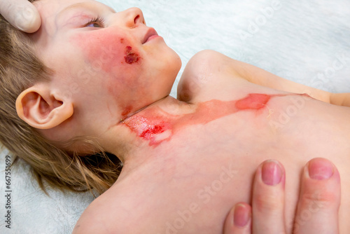 medical procedure dressing a boy with a first-degree burn from boiling water on his face, neck and chest