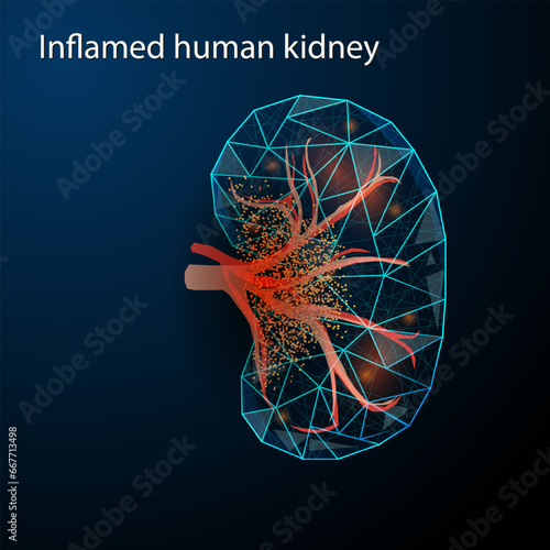 Polygonal vector illustration of an inflamed human kidney on a dark blue background. Diseases of the organs of the excretory system concept. Urological or nephrological.