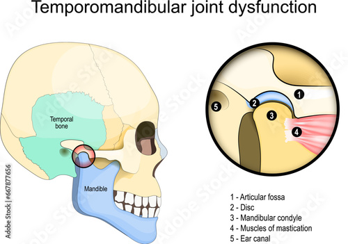 Temporomandibular joint dysfunction syndrome. Side view of a Human skull