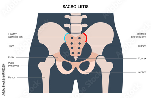 Sacroiliitis medical poster