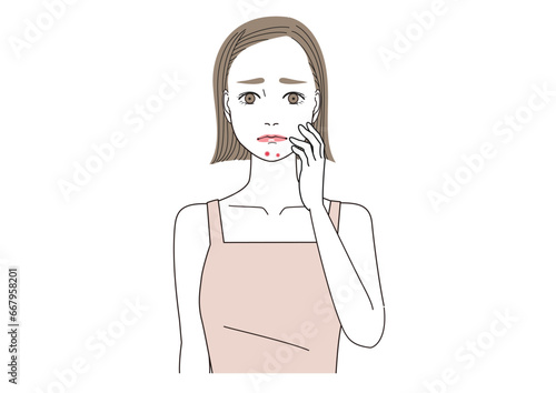 あごにニキビができて悩んでいる女性