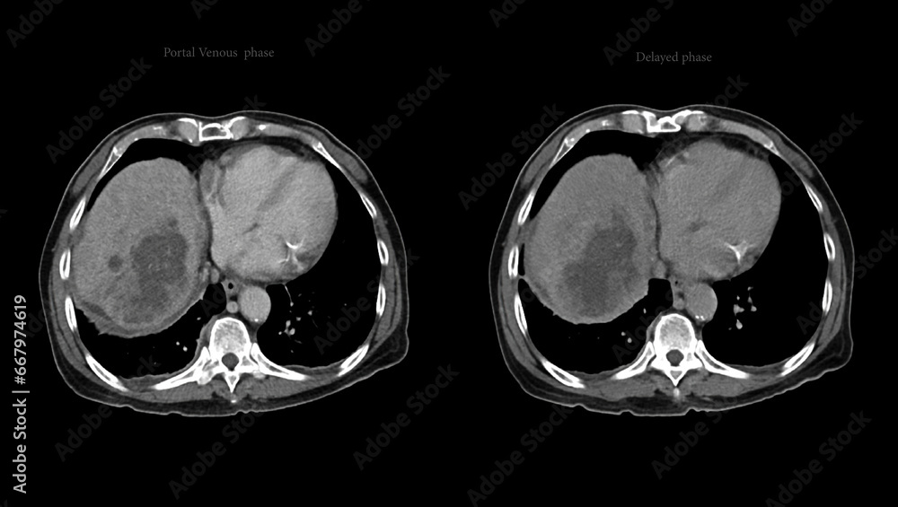CT upper abdomen DDX is atypical HCC or hepatocellular carcinoma. - obrazy, fototapety, plakaty 