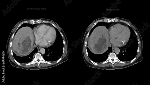 CT upper abdomen DDX is atypical HCC or hepatocellular carcinoma. photo