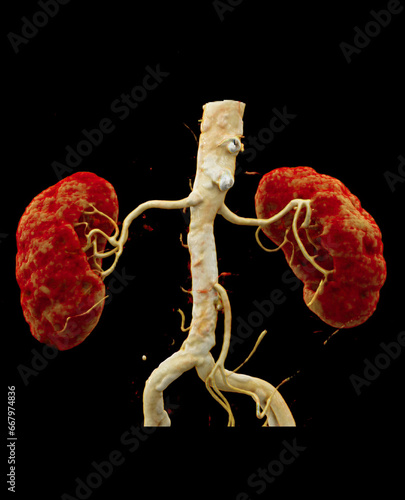 CTA Renal artery is a medical imaging procedure using CT scans to examine the renal arteries It provides detailed images of the blood vessels supplying the kidneys.