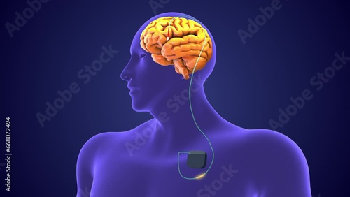 Deep brain stimulation medical concept photo