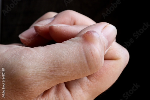 Ganglion cyst (synovial cyst disease) on the thumb of a woman’s hand. Selective focus. photo