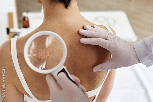 Close up of doctor holding magnifying glass while examining back of female patient with rash spots in dermatology clinic, copy space
