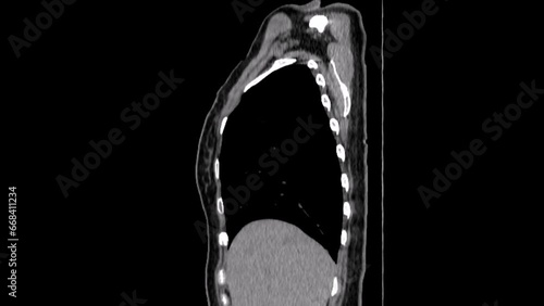 Achalasia of the oesophagus, CT scan
 photo