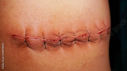 Quadro su tela Surgical stitches was made by surgeon at the end of surgery.