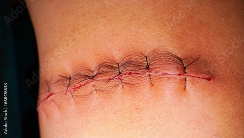 Quadro su tela Surgical stitches was made by surgeon at the end of surgery.