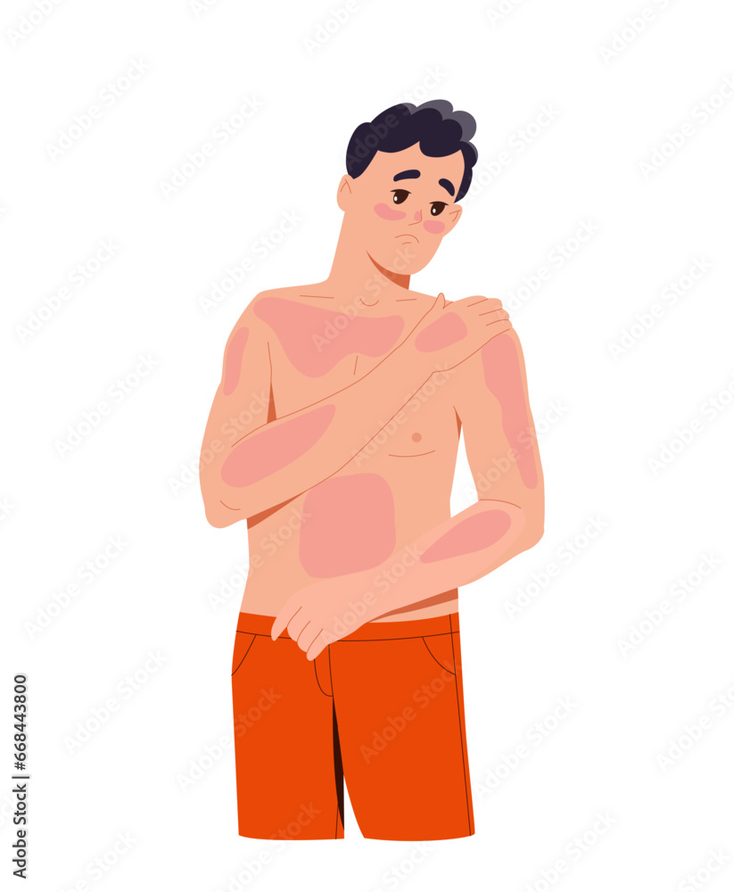 Fototapeta premium Sun burn person concept. Man with red spots at body. Young guy with skin problems and diseases. Graphic element for website. Cartoon flat vector illustration isolated on white background