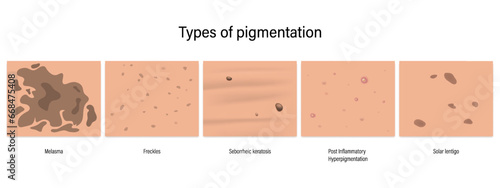 Types of pigmentation vector. Melasma, Freckles, Seborrheic keratosis, Post Inflammatory
Hyperpigmentation and Solar lentigo. photo