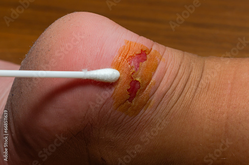 Doctor provides first aid, treats a wound - a callus on a child's foot