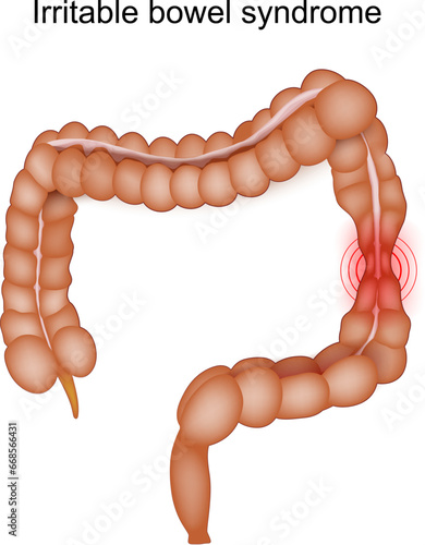 Irritable Bowel Syndrome. IBS Symptoms.