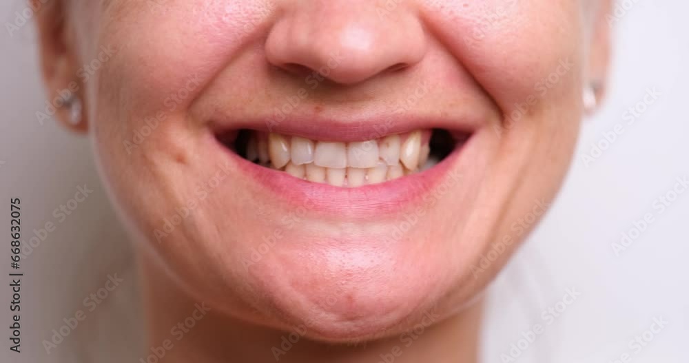Restoration of chipped teeth and injuries and damage. Closeup of smiling woman with chipped front tooth Restoration of chipped teeth and injuries and damage. Closeup of smiling woman with chipped front tooth