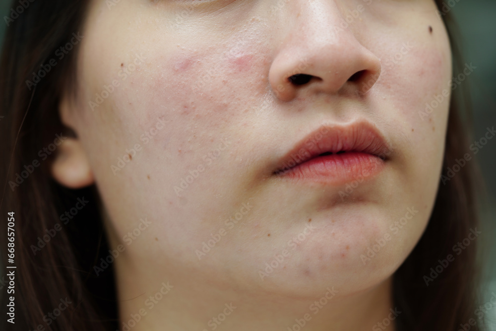 Obraz premium Acne pimple and scar on skin face, disorders of sebaceous glands, teenage girl skincare beauty problem.