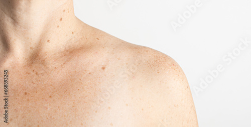 Upper torso of white woman with nevus, moles, spots on the skin, isolated white background. Skin diseases. Insolation. Sun spots. Close up.