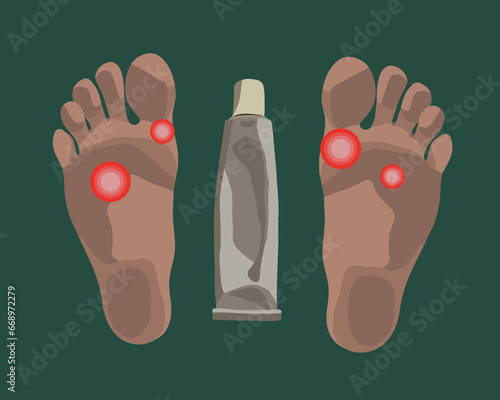 Vector isolated illustration of foot fungus. Fungal ointment.