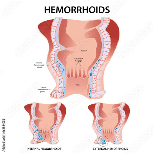 Hemorrhoids Inner and External Hemorrhoids Illustration
