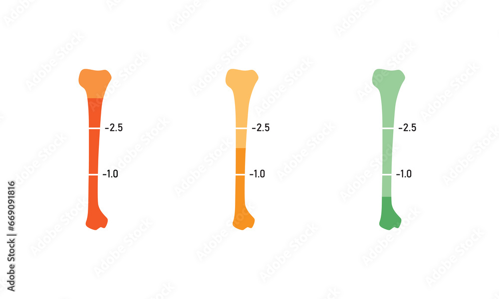 Bone Mineral Density Level Concept Design. Vector Illustration. Bone Mineral Density Level Concept Design. Vector Illustration.