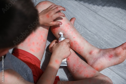atopic dermatitis on the legs of a child photo