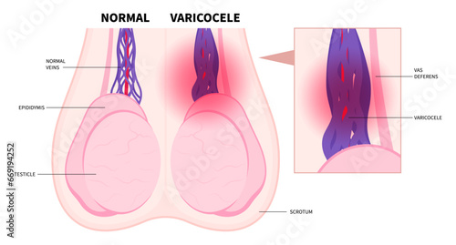 The epididymis infection anatomy in sperm semen tube of male with acute vein cyst tumor pelvic pain and blood test for viral penile fluid tract system pus trauma or prostate testis disorder