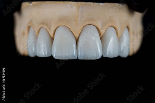 carillas dentales sobre molde, dientes cerámica  photo