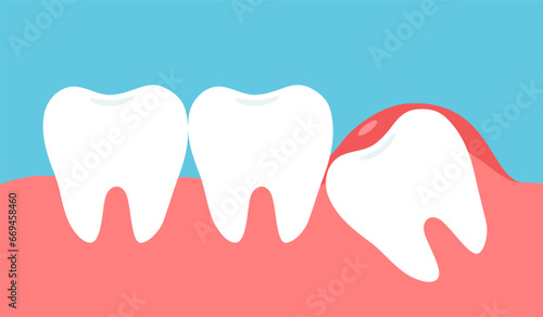 Impacted tooth inside under inflammation gum in flat design.