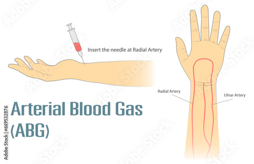 Arterial Blood Gas ABG test insert the needle at radial artery on wrist. Medical procedure vector isolated illustration on white background