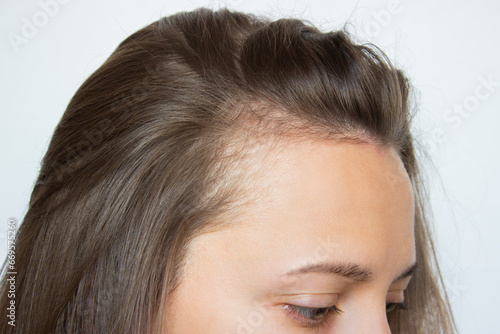 Cropped head shot of a young Caucasian woman with receding hairline on her forehead and temples. Baldness. Close-up, side view. Hair care and treatment concept. Hair loss, alopecia.