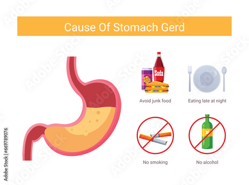 Vector design causes of stomach gerd