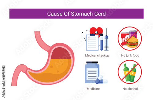 Causes of stomach gerd illustration