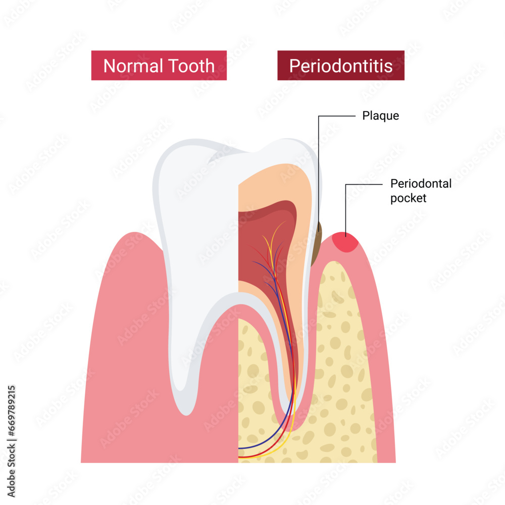 Normal human teeth compared to periodontitis Normal human teeth compared to periodontitis