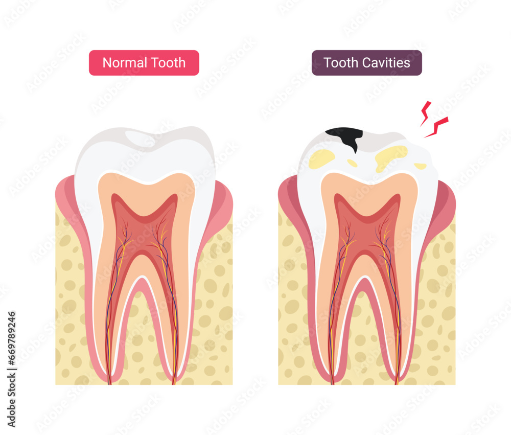 Normal human teeth compared to cavities Normal human teeth compared to cavities
