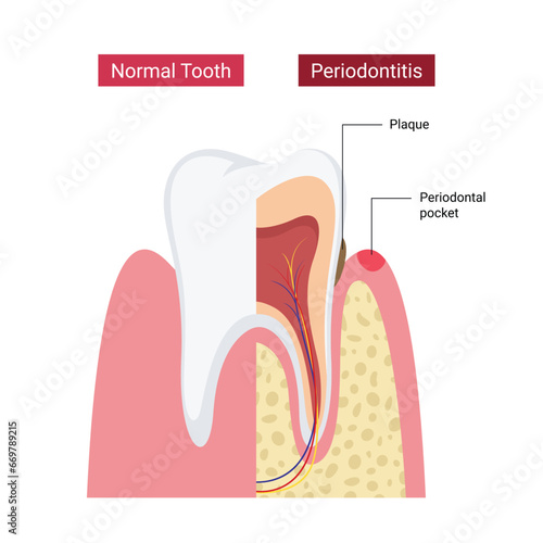 Normal human teeth compared to periodontitis