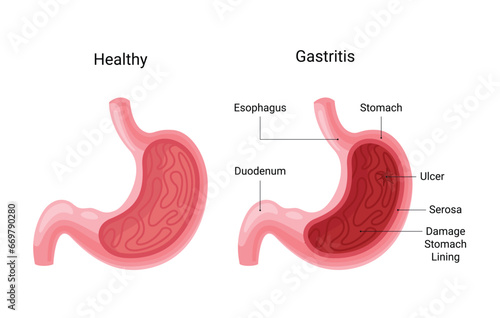 Normal human stomach compared with gastritis