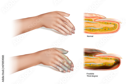 Frostbite Third degree. Skin injury that occurs when exposed to extreme low temperatures, causing the freezing of the skin or other tissues. 