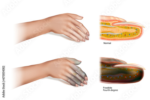 Frostbite Fourth degree. Skin injury that occurs when exposed to extreme low temperatures, causing the freezing of the skin or other tissues. 
